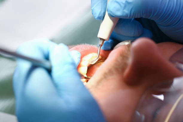 Best Emergency Root Canal Treatment in Matthews, NC